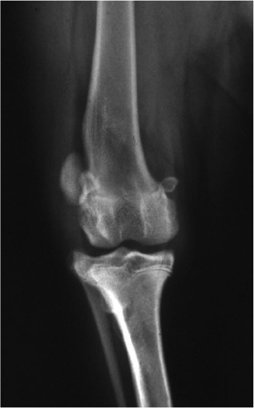 knieschijf (patella)